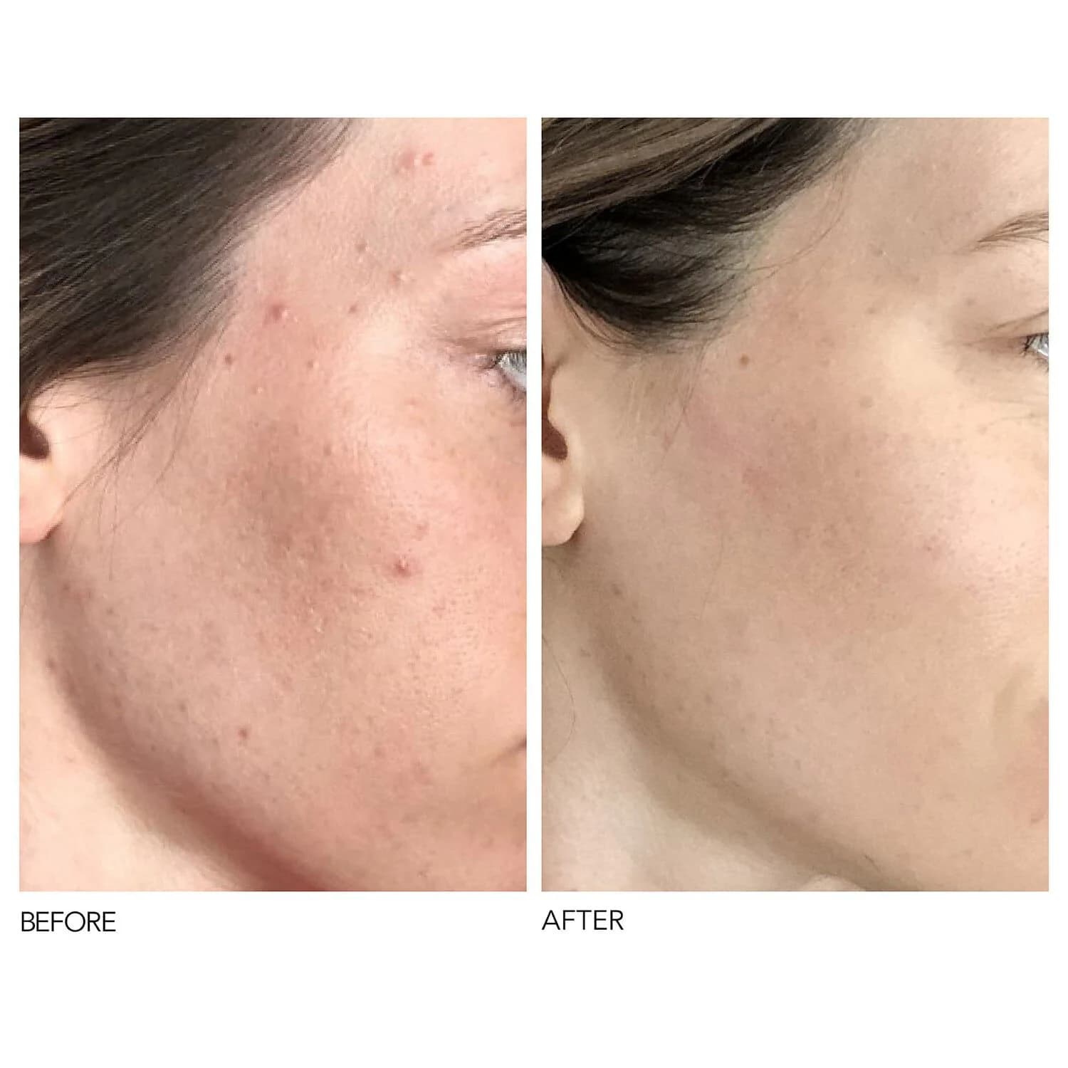 Alpha Beta® Universal Daily Peel