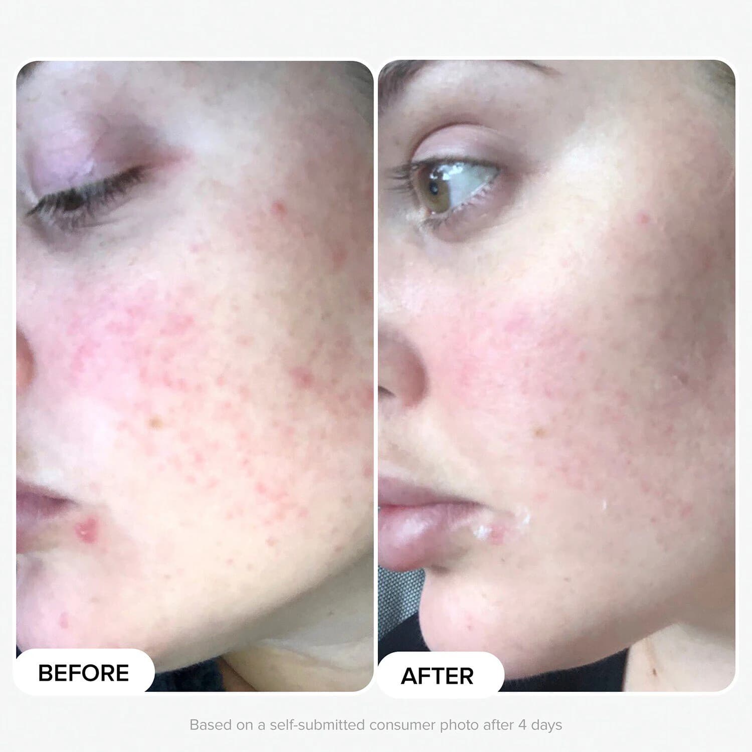 10% Azelaic Acid Booster