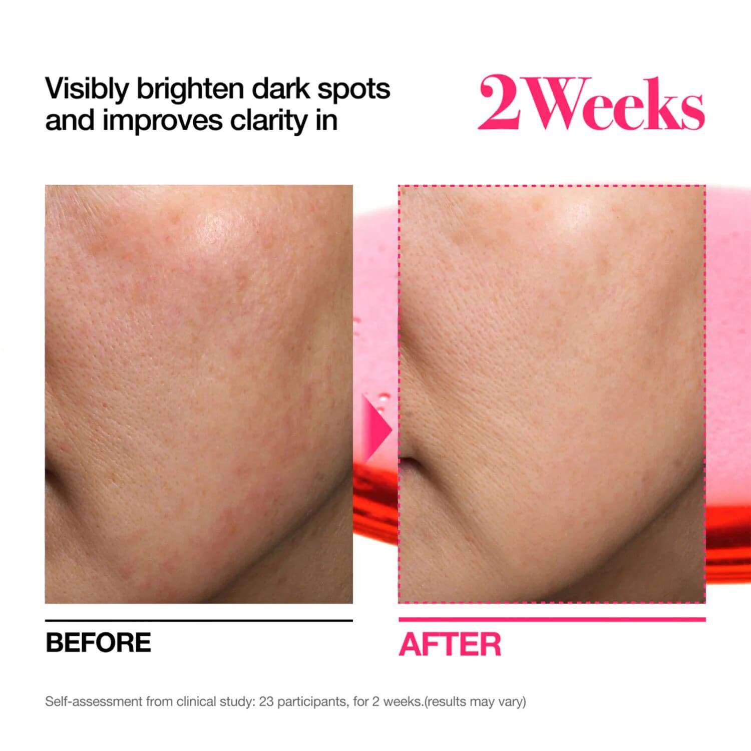 Mini for Dark Spot TXA4