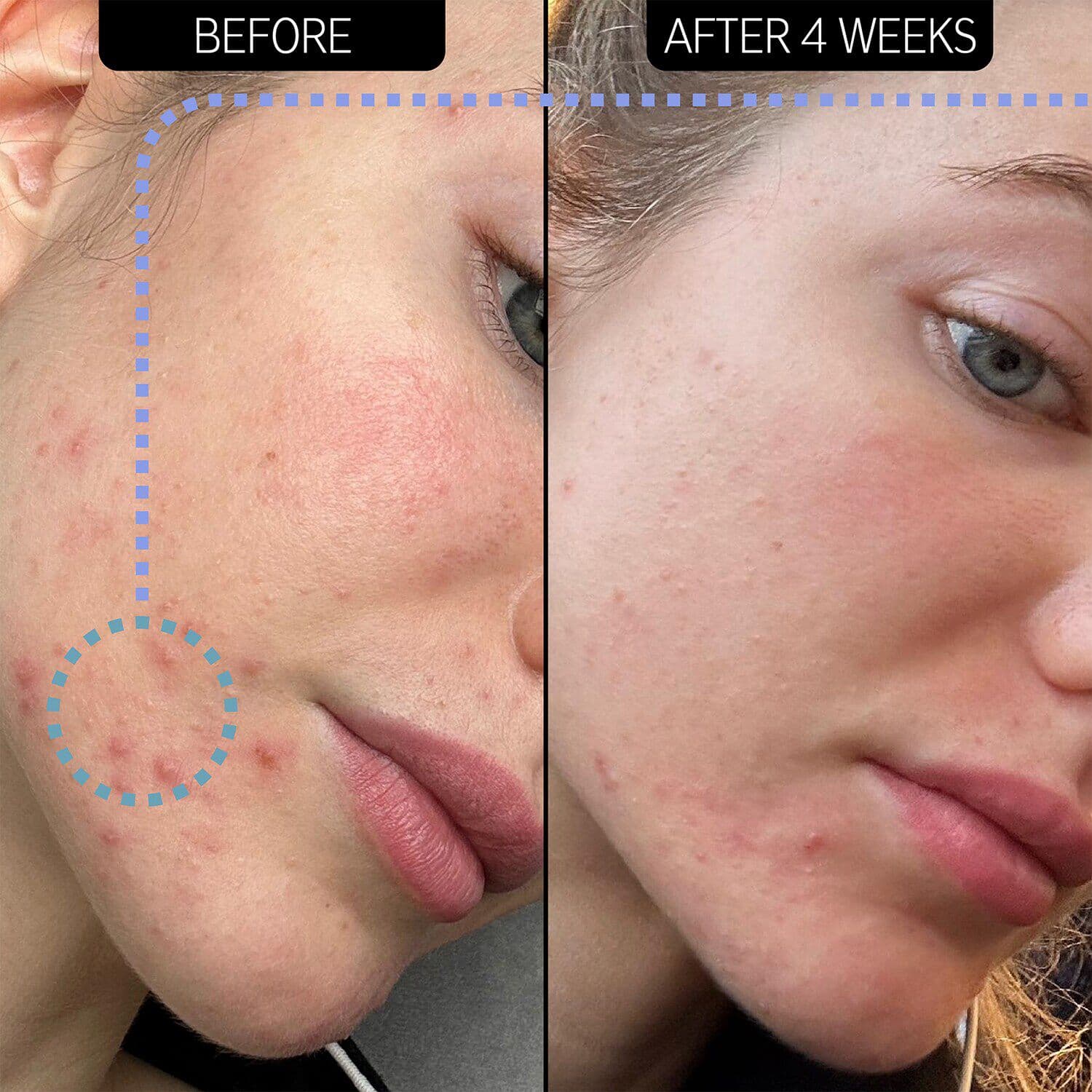 Blemish Clearing Moisturizer - 2% NovoRetin™