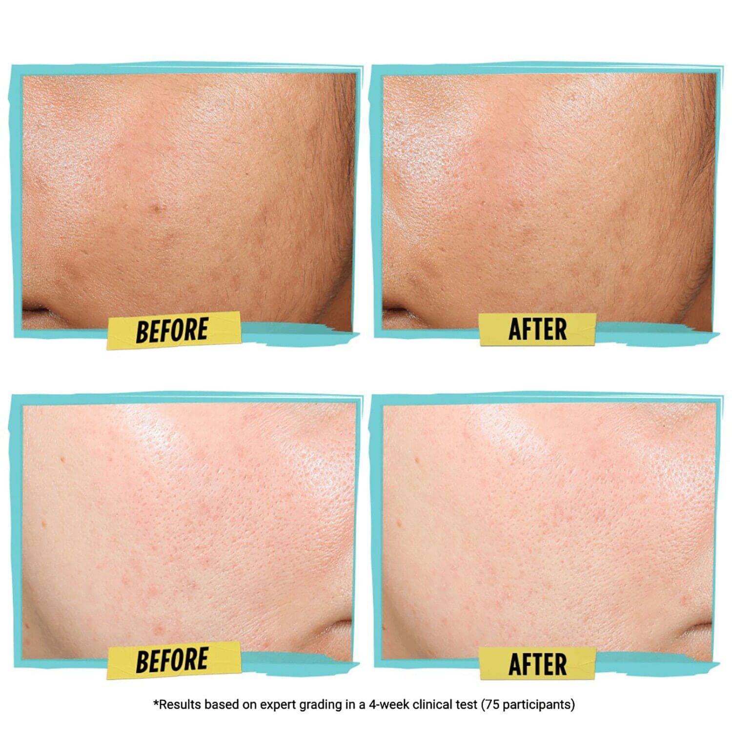 Expertly Clear Blemish-treating & Preventing Lotion