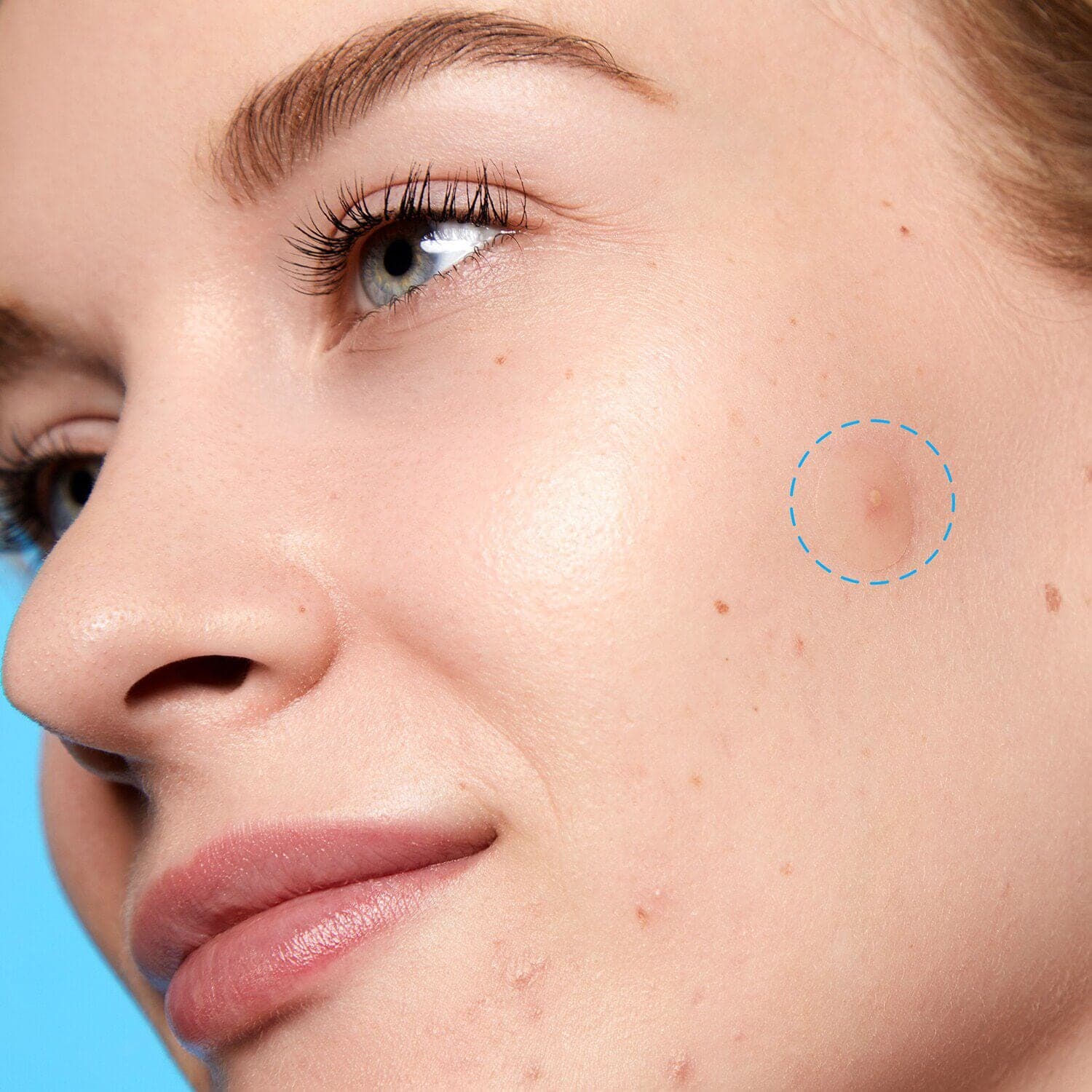 Acne Day Dot Jumbo