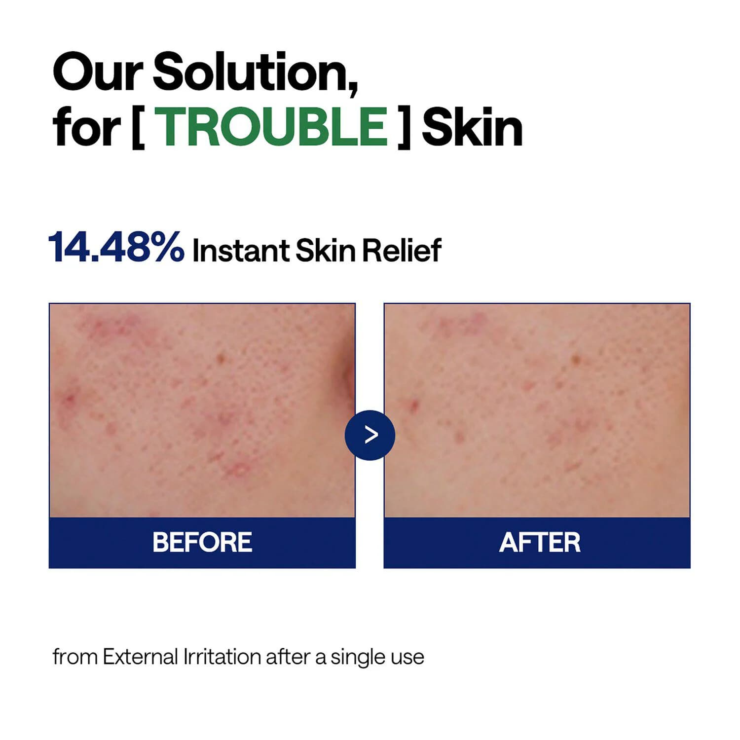 Teatree Serum