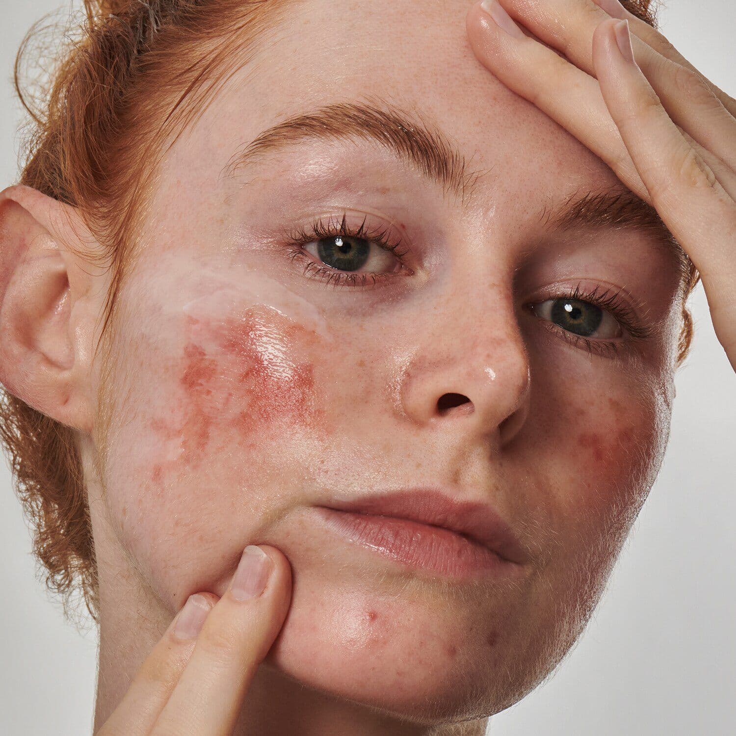 SuperSolutionsᐩ 10% Azelaic Acid Serum