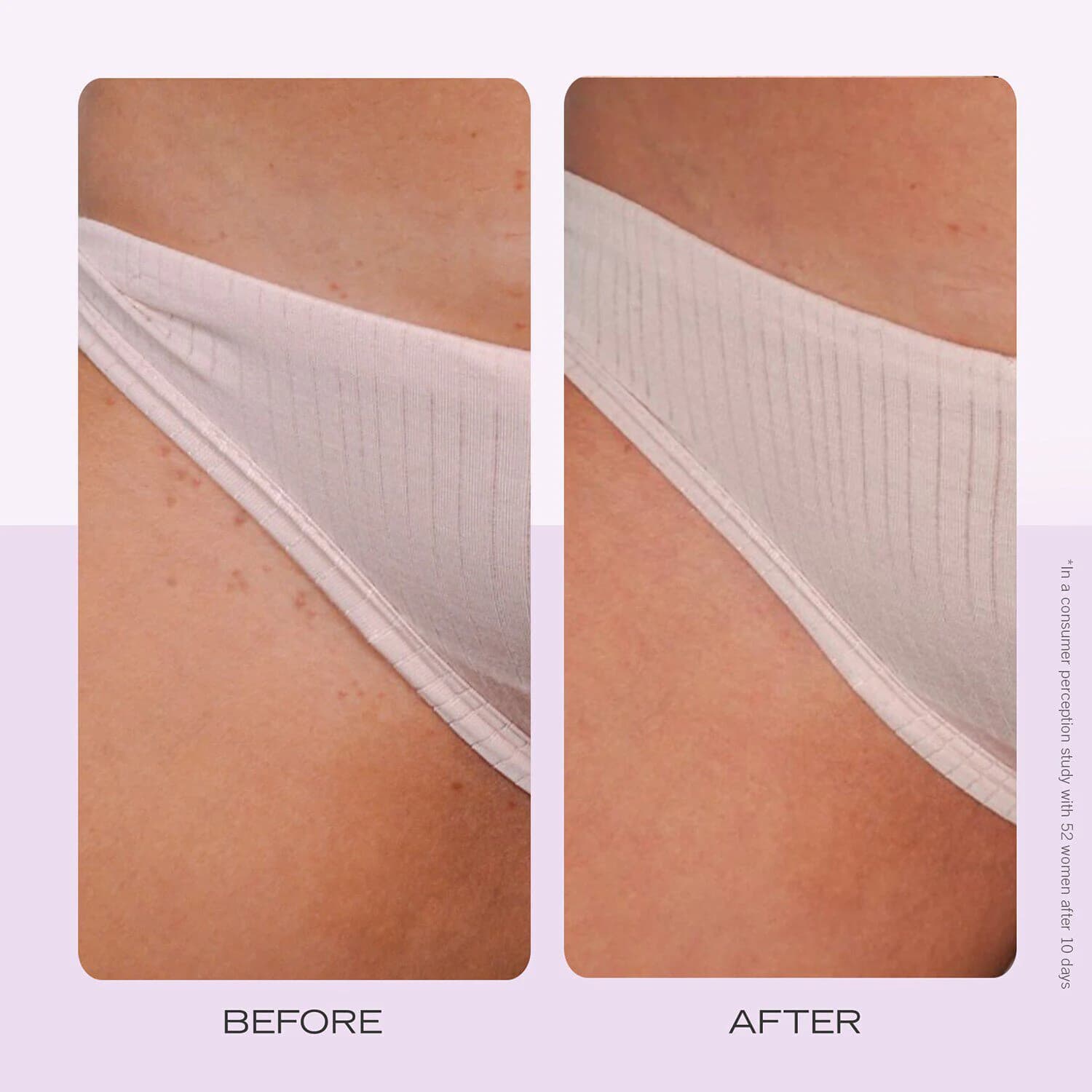 Ingrown Hair Pads with BHA and AHA