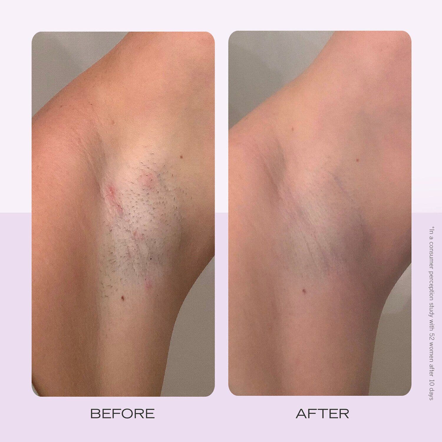 Ingrown Hair Pads with BHA and AHA