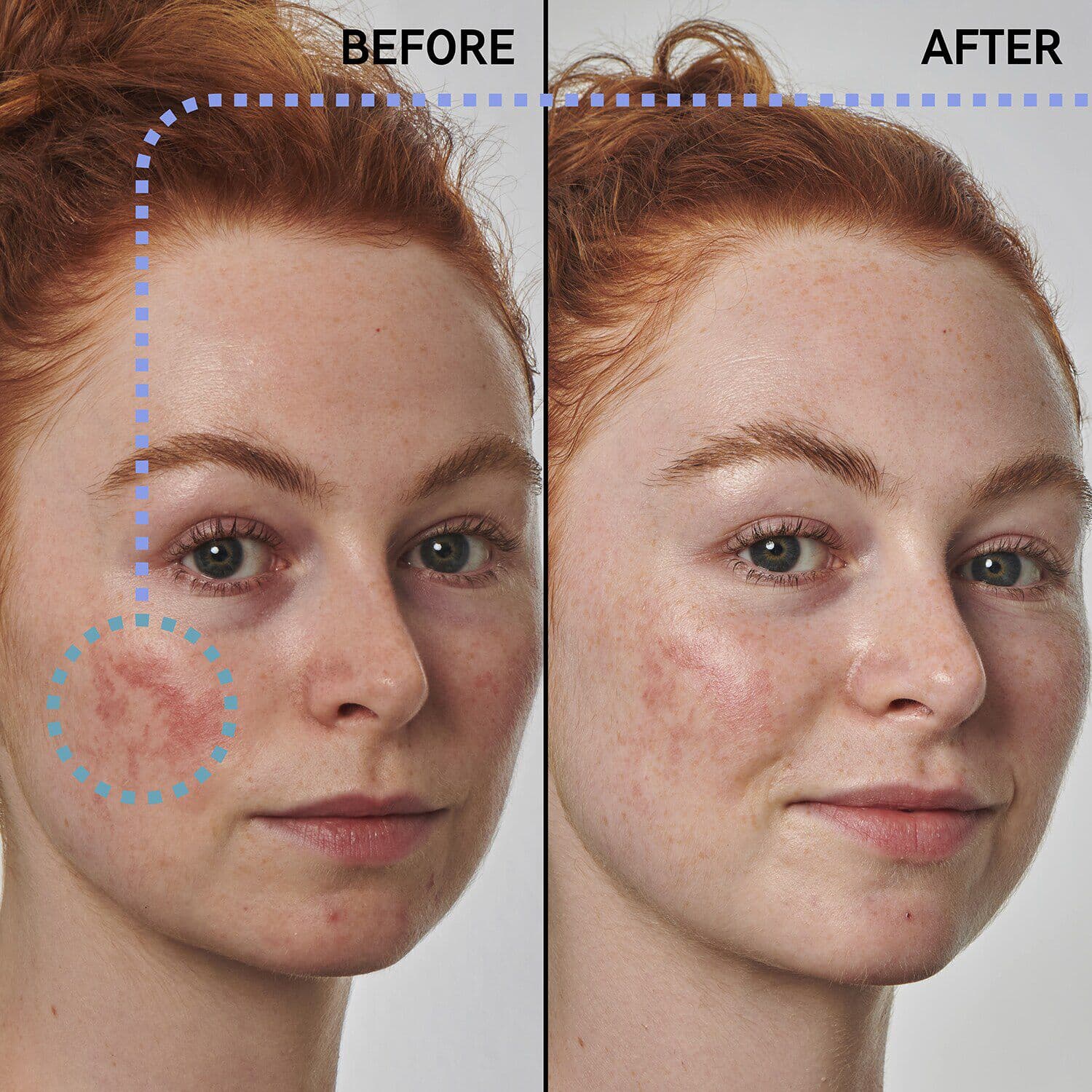 SuperSolutionsᐩ 10% Azelaic Acid Serum