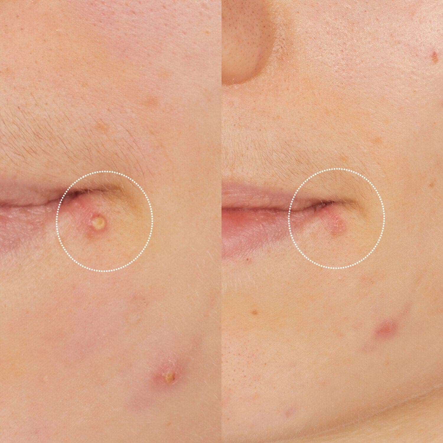 Vinopure Salicylic Stop Solution