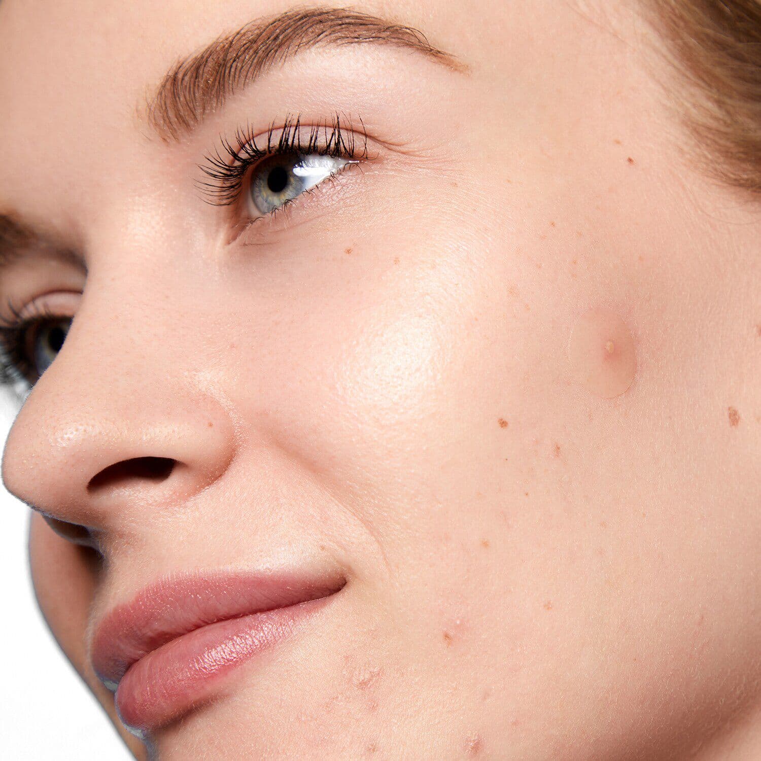 Acne Day Dot