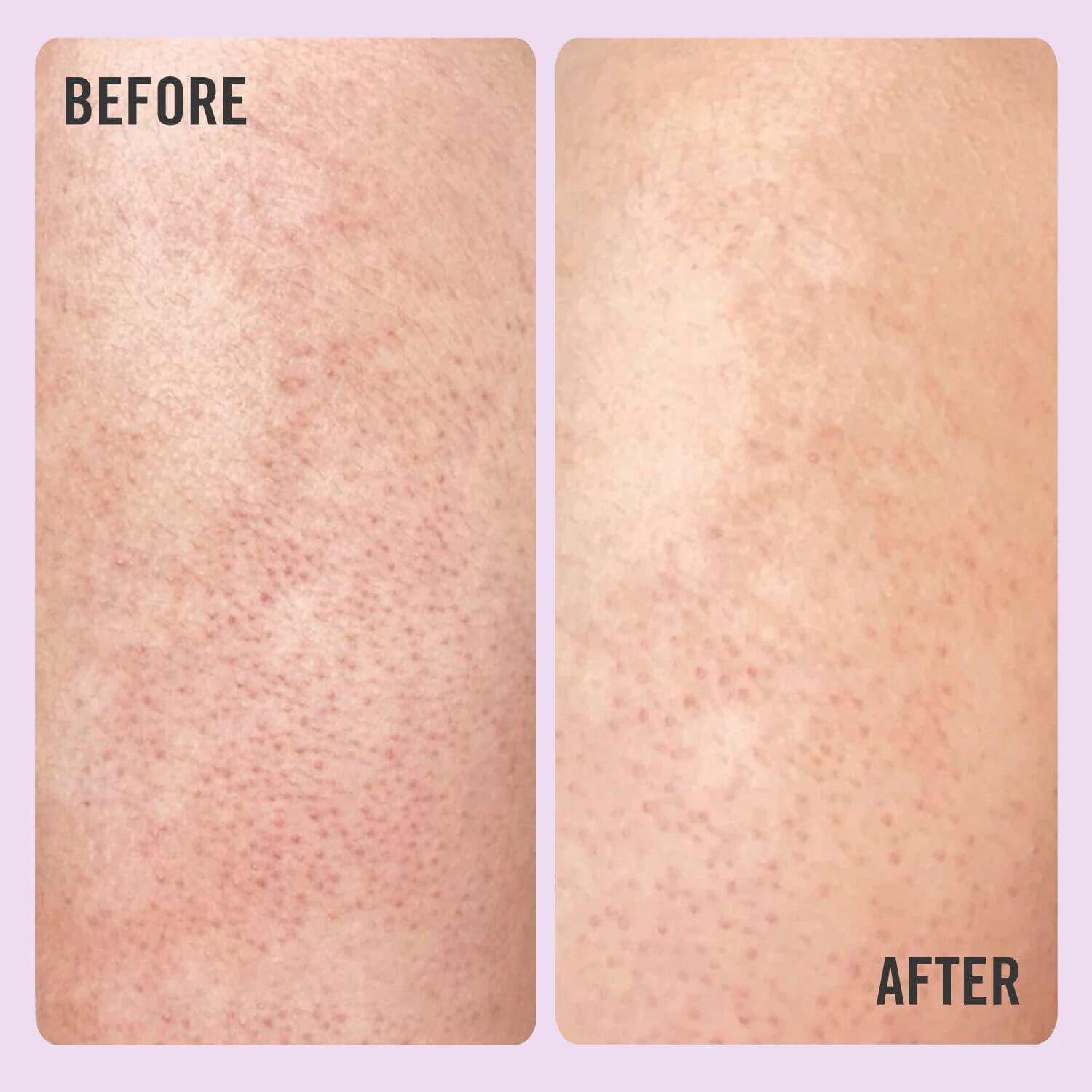 KP Bump Eraser Body Scrub with 10% AHA
